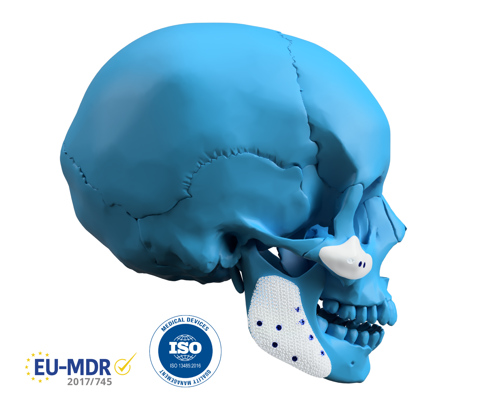 MyBone® for facial contouring | Patient-specific implants by Cerhum
